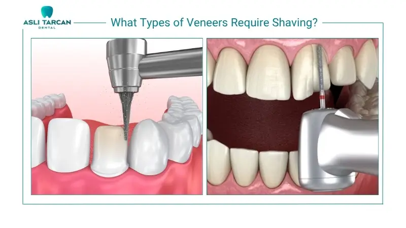What Types of Veneers Require Shaving