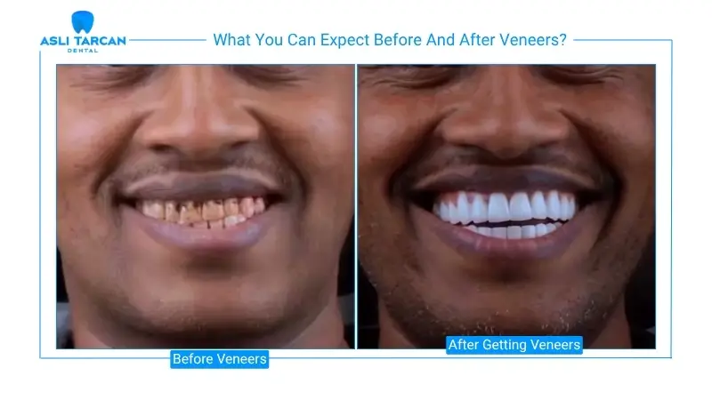What You Can Expect Before And After Veneers