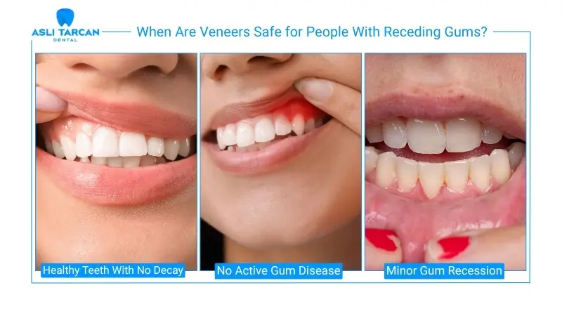 When Are Veneers Safe for People With Receding Gums