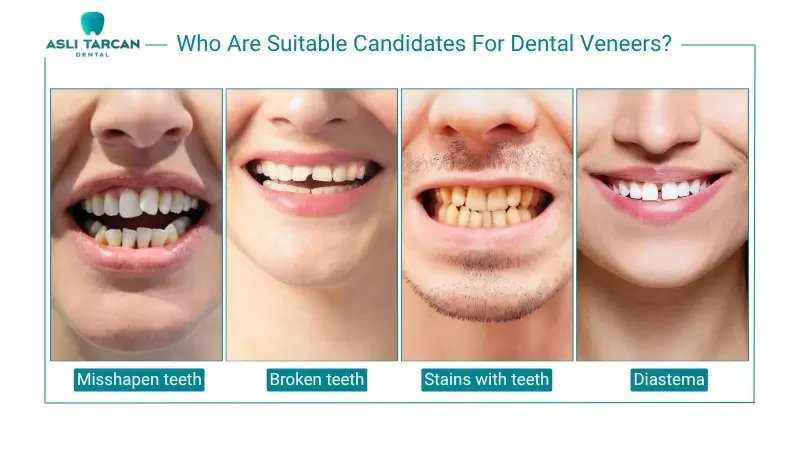 Who Are Suitable Candidates For Dental Veneers