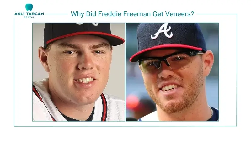 Why Did Freddie Freeman Get Veneers